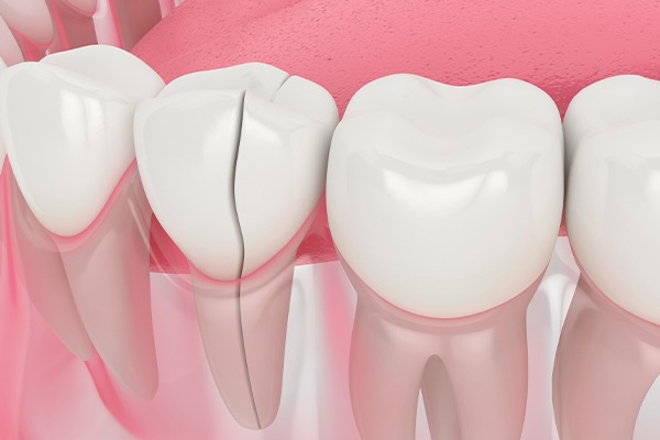 Calgary Dental Crown | Key Prosthodontics | Prosthodontic Specialist | SW Calgary