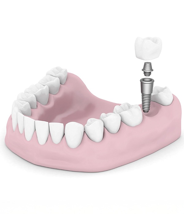 What Are Some Advantages of a Dental Implant | Key Prosthodontics Specialist SW Calgary