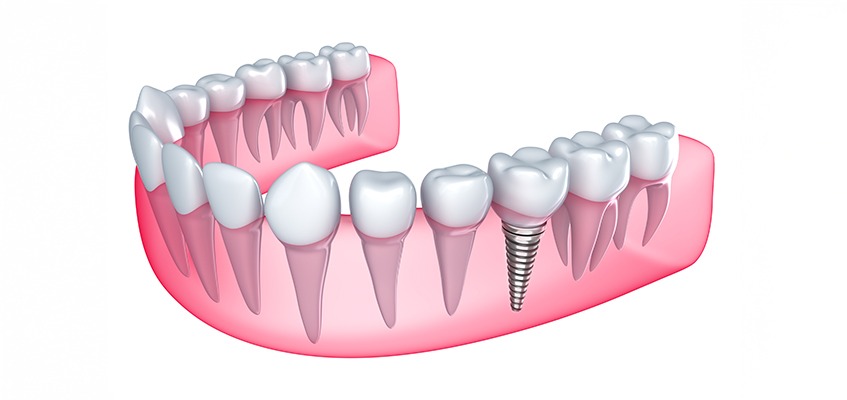 Calgary Dental Implants | Key Prosthodontics | SW Calgary | Prosthodontic Specialist